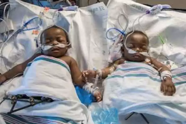 Nigerian conjoined twins successfully separated in US [PHOTO]